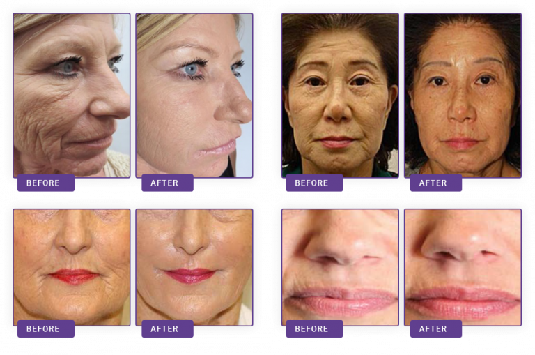 after-before-facial-768x509 https://www.naturomedical.com/wp-content/uploads/2020/09/after-before-facial-768x509-1.png