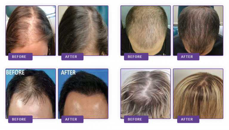 after-before-hair-768x436 https://www.naturomedical.com/wp-content/uploads/2020/09/after-before-hair-768x436-1.png